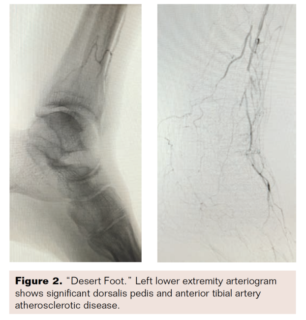 Pedal Revascularization Vascular Disease Management